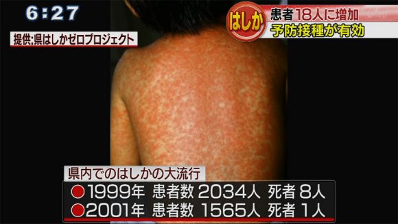 はしか感染拡大 発生状況レベル3に引き上げ