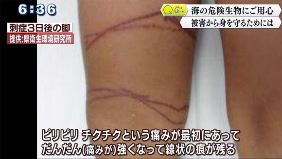 Qプラスリポート 海の危険生物にご用心 ハブクラゲの被害から身を守るために