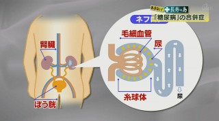 あぶない!長寿の島 「糖尿病」が引き起こす病気