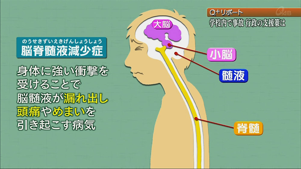 病気 漏れる 液 髄 が