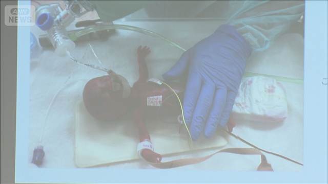 赤ちゃんの心臓治療に成功　“世界最小”356gの時に
